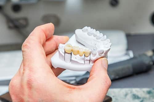 O’fallon dental bridges Partial dental bridge being made at o'fallon dental works in missouri